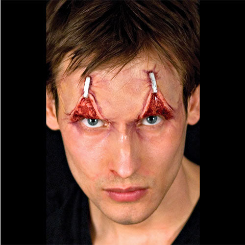 Stapled upturned eyelids